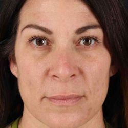 Rhinoplasty Before & After Patient #5969