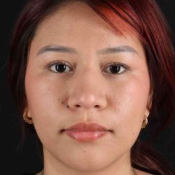 Rhinoplasty Before & After Patient #5983