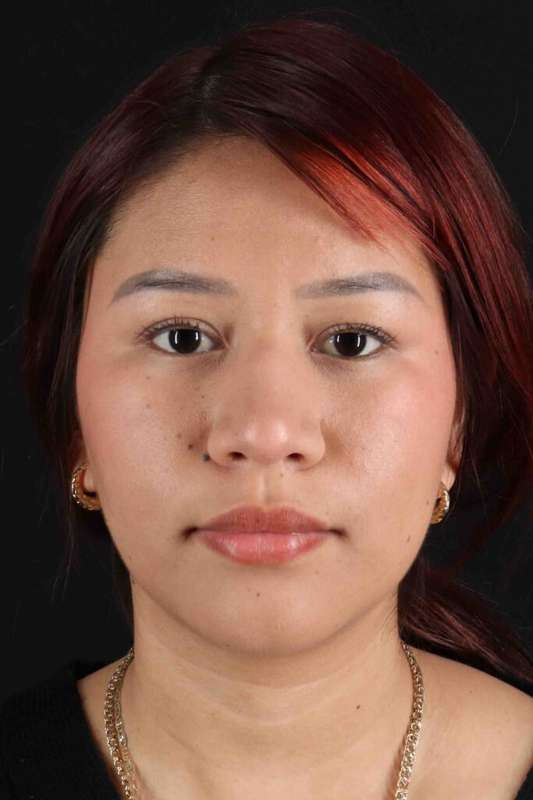 Rhinoplasty Before & After Patient #5983