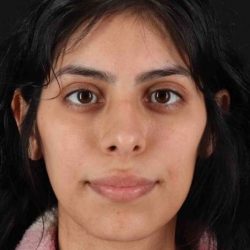 Rhinoplasty Before & After Patient #5994