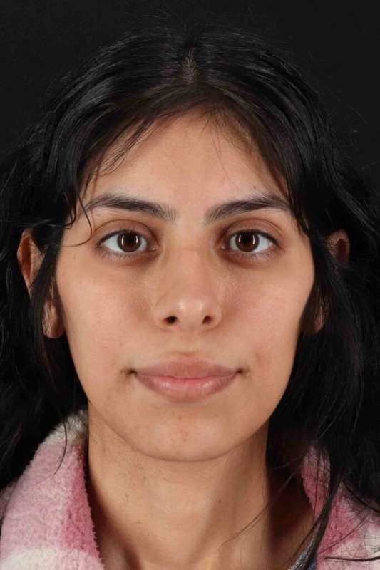 Rhinoplasty Before & After Patient #5994
