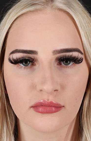 Rhinoplasty Before & After Patient #6005