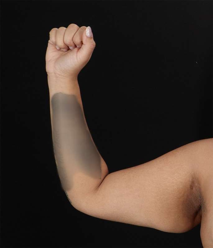 Brachioplasty (Arm Lift) Before & After Patient #1150