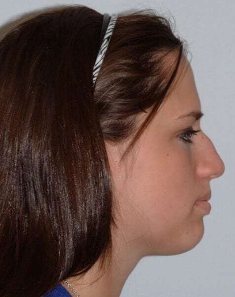 Rhinoplasty Before & After Patient #6008