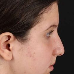 Rhinoplasty Before & After Patient #6014