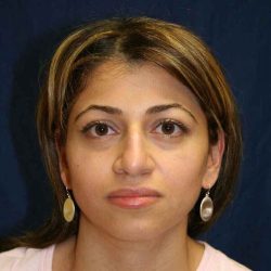 Rhinoplasty Before & After Patient #6021