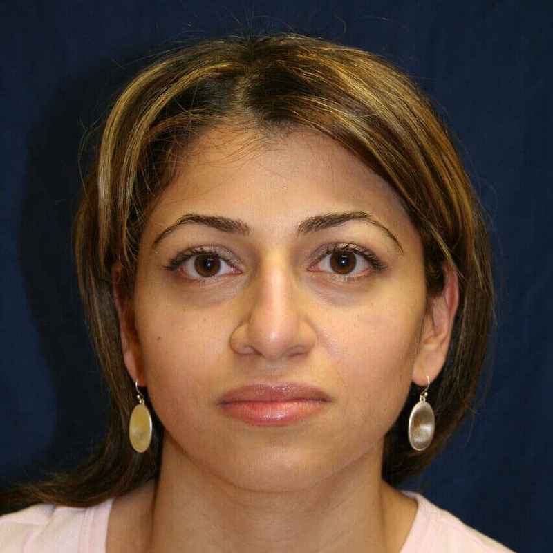 Rhinoplasty Before & After Patient #6021