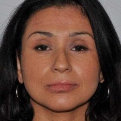 Rhinoplasty Before & After Patient #6035