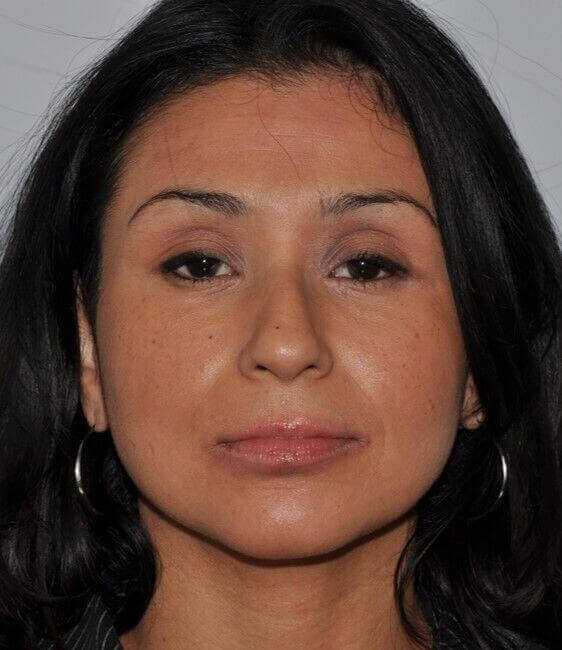 Rhinoplasty Before & After Patient #6035