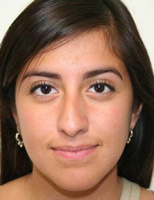 Rhinoplasty Before & After Patient #6040