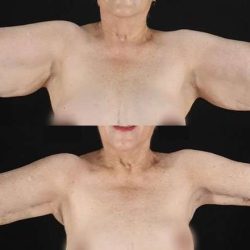 Brachioplasty (Arm Lift) Before & After Patient #1153