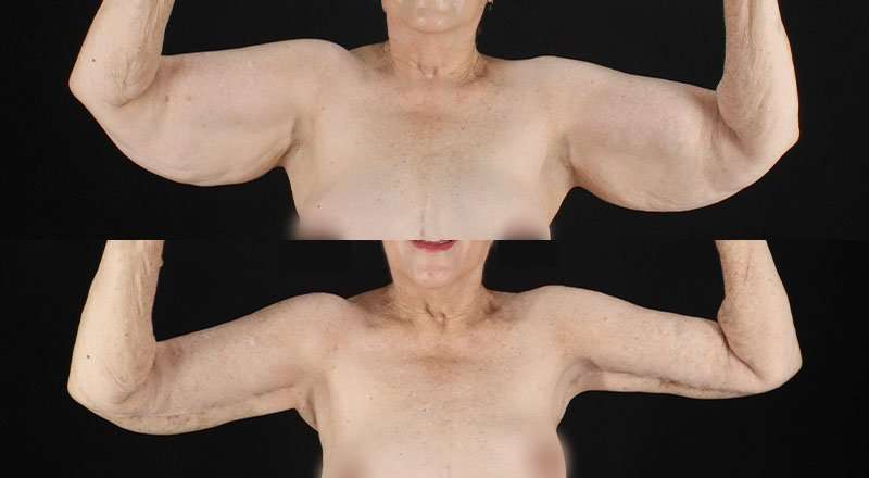 Brachioplasty (Arm Lift) Before & After Patient #1153