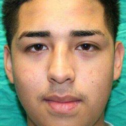 Rhinoplasty Before & After Patient #6068