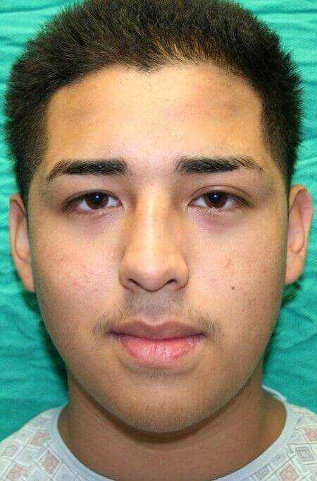 Rhinoplasty Before & After Patient #6068