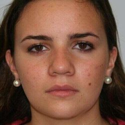 Rhinoplasty Before & After Patient #6075
