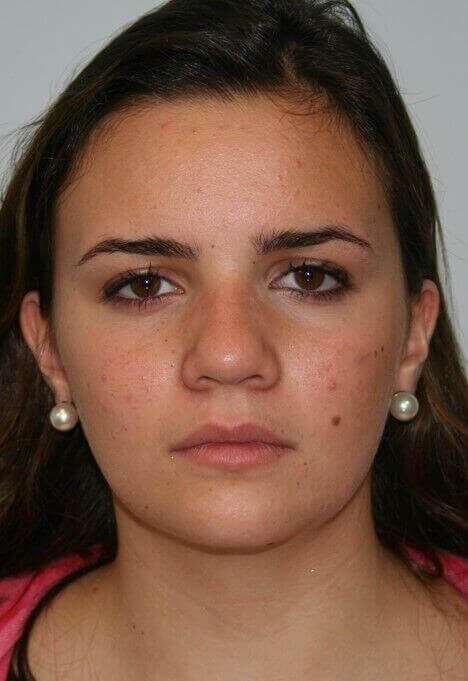 Rhinoplasty Before & After Patient #6075