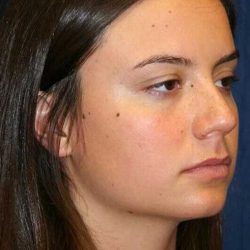 Rhinoplasty Before & After Patient #6080