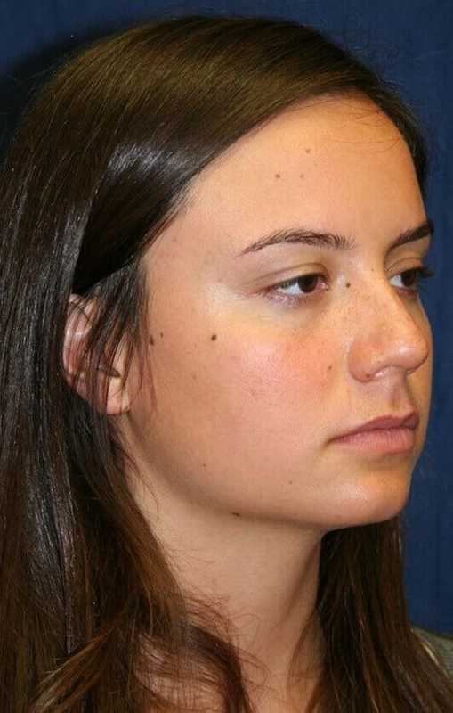 Rhinoplasty Before & After Patient #6080