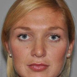 Rhinoplasty Before & After Patient #6087