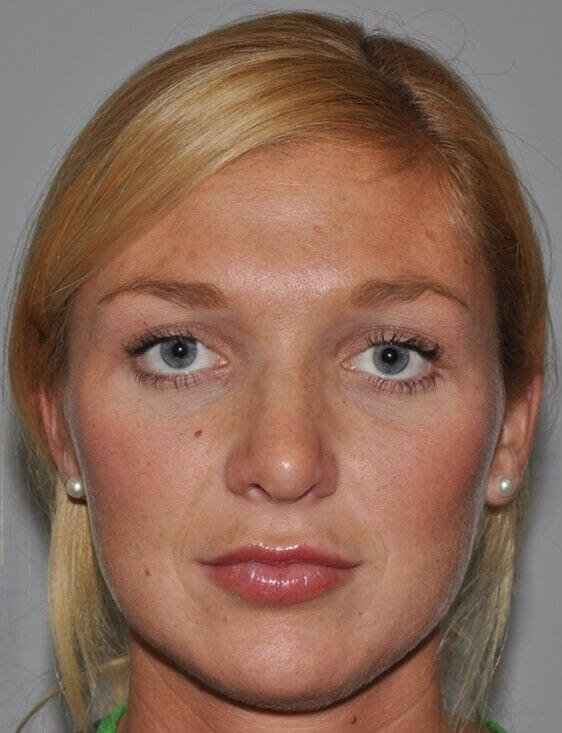 Rhinoplasty Before & After Patient #6087