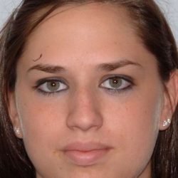 Rhinoplasty Before & After Patient #6092