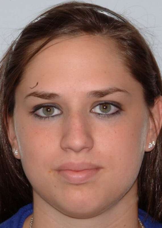 Rhinoplasty Before & After Patient #6092