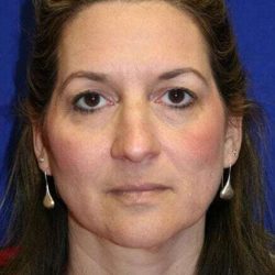 Rhinoplasty Before & After Patient #6099