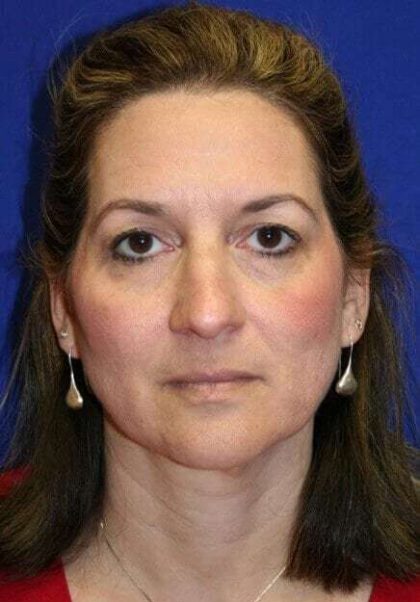 Rhinoplasty Before & After Patient #6099