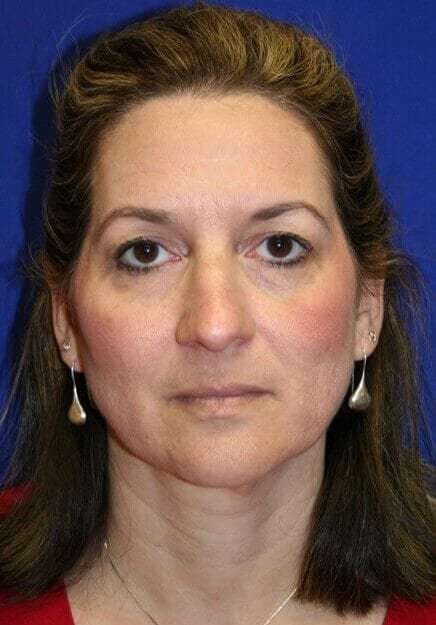Rhinoplasty Before & After Patient #6099