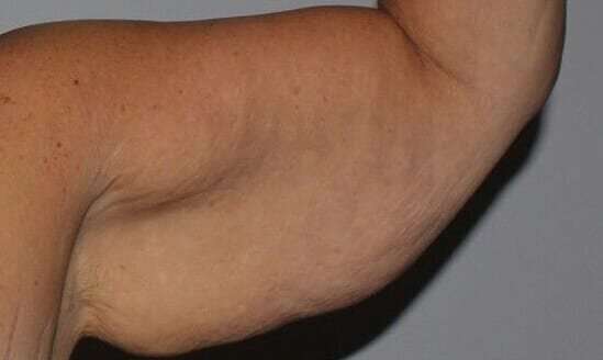 Brachioplasty (Arm Lift) Before & After Patient #1160