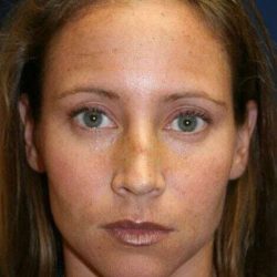 Rhinoplasty Before & After Patient #6132