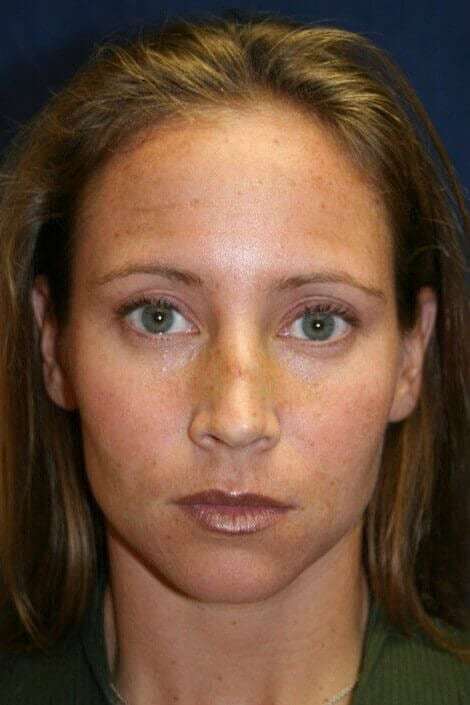 Rhinoplasty Before & After Patient #6132