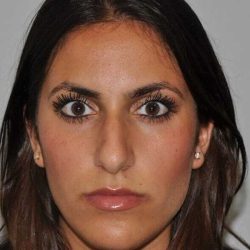 Rhinoplasty Before & After Patient #6139