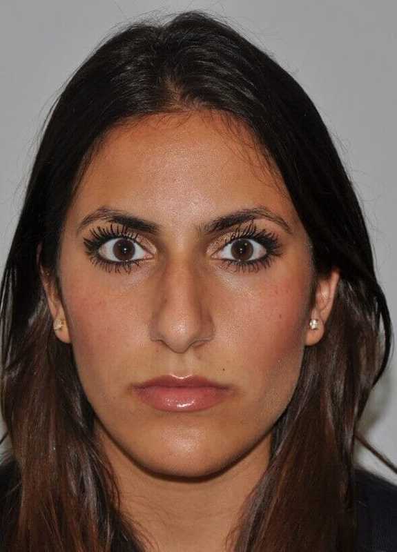 Rhinoplasty Before & After Patient #6139