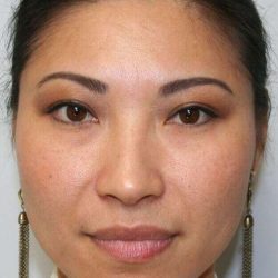 Rhinoplasty Before & After Patient #6146