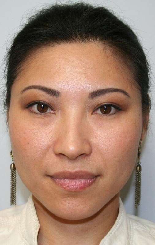 Rhinoplasty Before & After Patient #6146