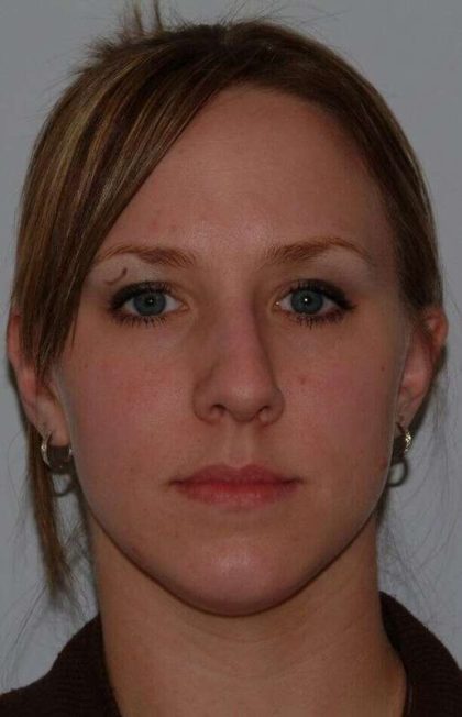 Rhinoplasty Before & After Patient #6153