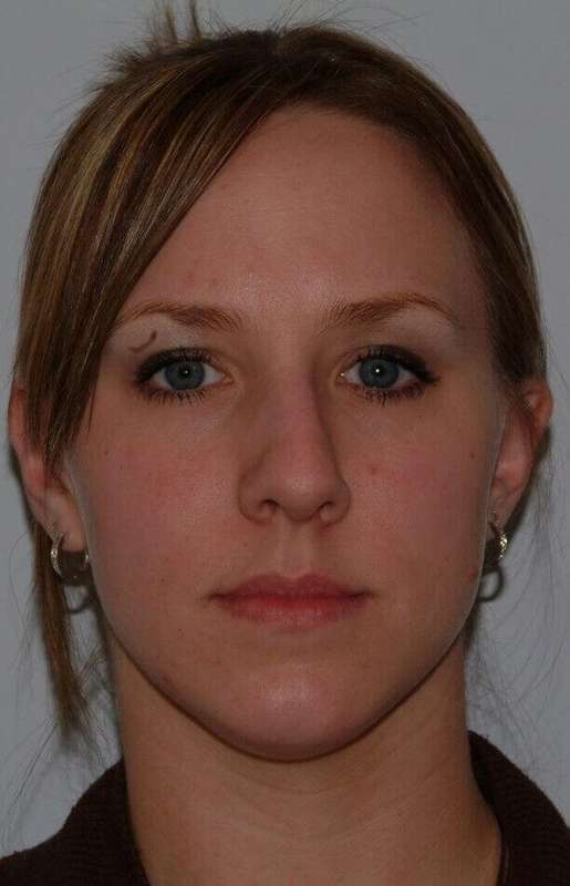 Rhinoplasty Before & After Patient #6153