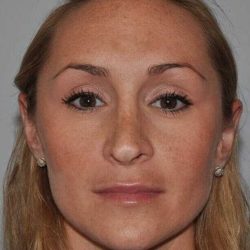 Rhinoplasty Before & After Patient #6160