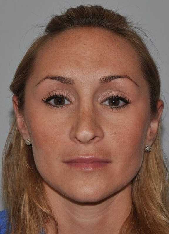 Rhinoplasty Before & After Patient #6160