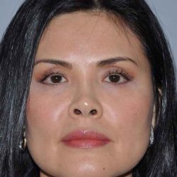 Rhinoplasty Before & After Patient #6167