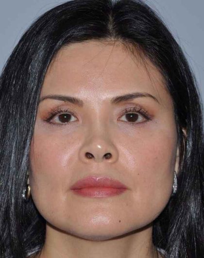 Rhinoplasty Before & After Patient #6167