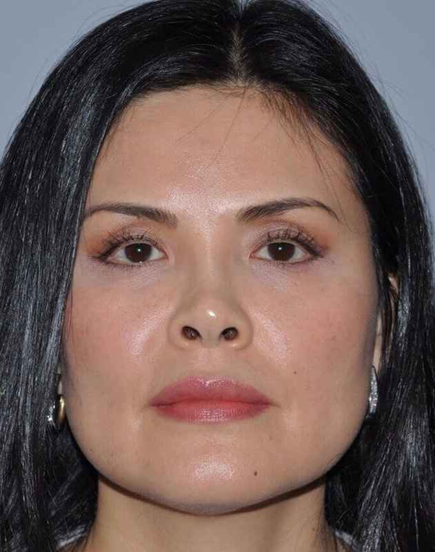 Rhinoplasty Before & After Patient #6167