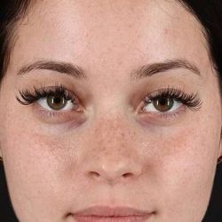 Rhinoplasty Before & After Patient #6178