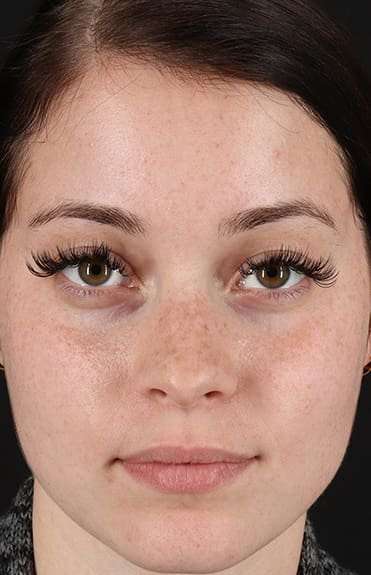 Rhinoplasty Before & After Patient #6178
