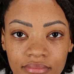 Rhinoplasty Before & After Patient #6189