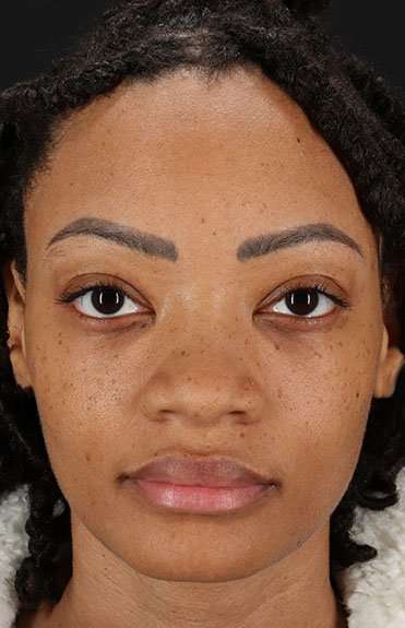 Rhinoplasty Before & After Patient #6189