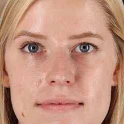 Rhinoplasty Before & After Patient #6200