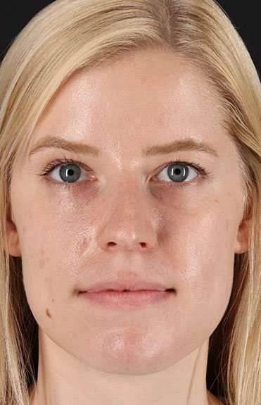 Rhinoplasty Before & After Patient #6200