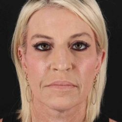 Rhinoplasty Before & After Patient #6211